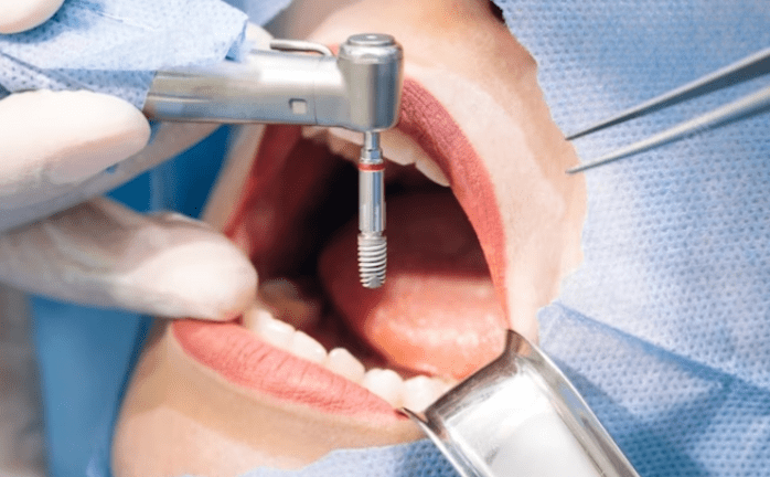 імплантація зубів хмельницький