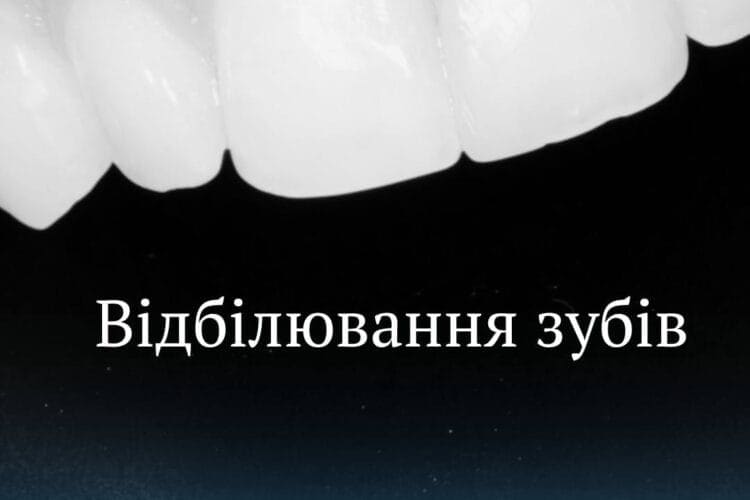 Професійне відбілювання зубів у Va Clinic, Хмельницький біла усмішка за один візит