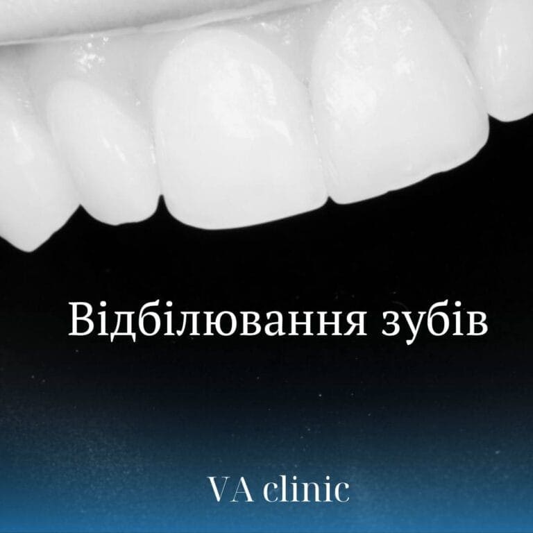Чи можна відбілювати зуби після лікування каналів