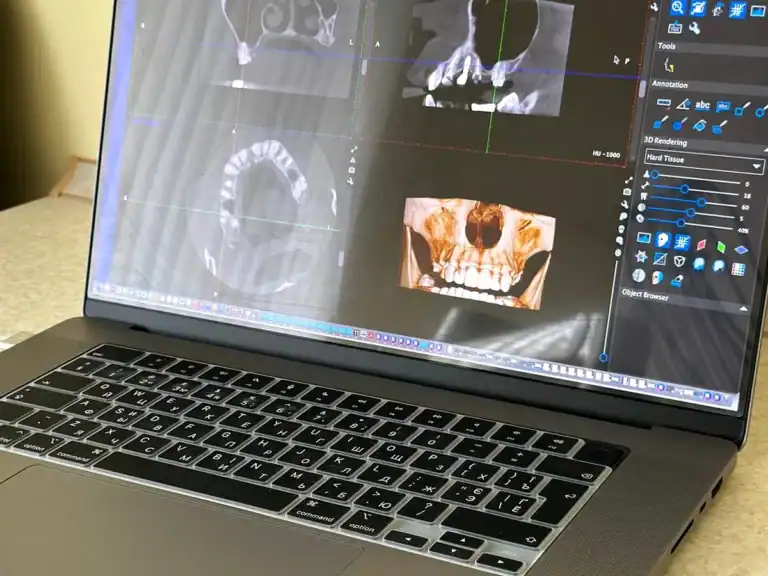 КТ зубів: що показує 3D-дослідження